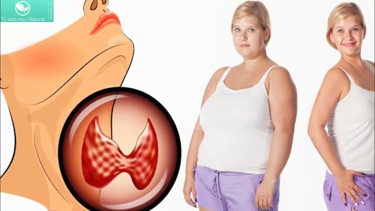 похудение после гормонов. дефицит прогестерона у женщин симптомы. таблица заболевания причины симптомы щитовидной железы. гипотиреоз щитовидной железы. гормональные нарушение при похудении.