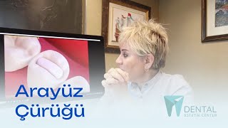 Arayüz Çürüğü Ve Tedavisi