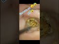 鼓膜からのきれいな肌の除去とドライクリーニング#Shorts