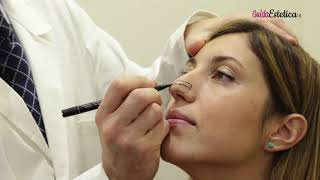 Rinoplastica Cosa Sapere