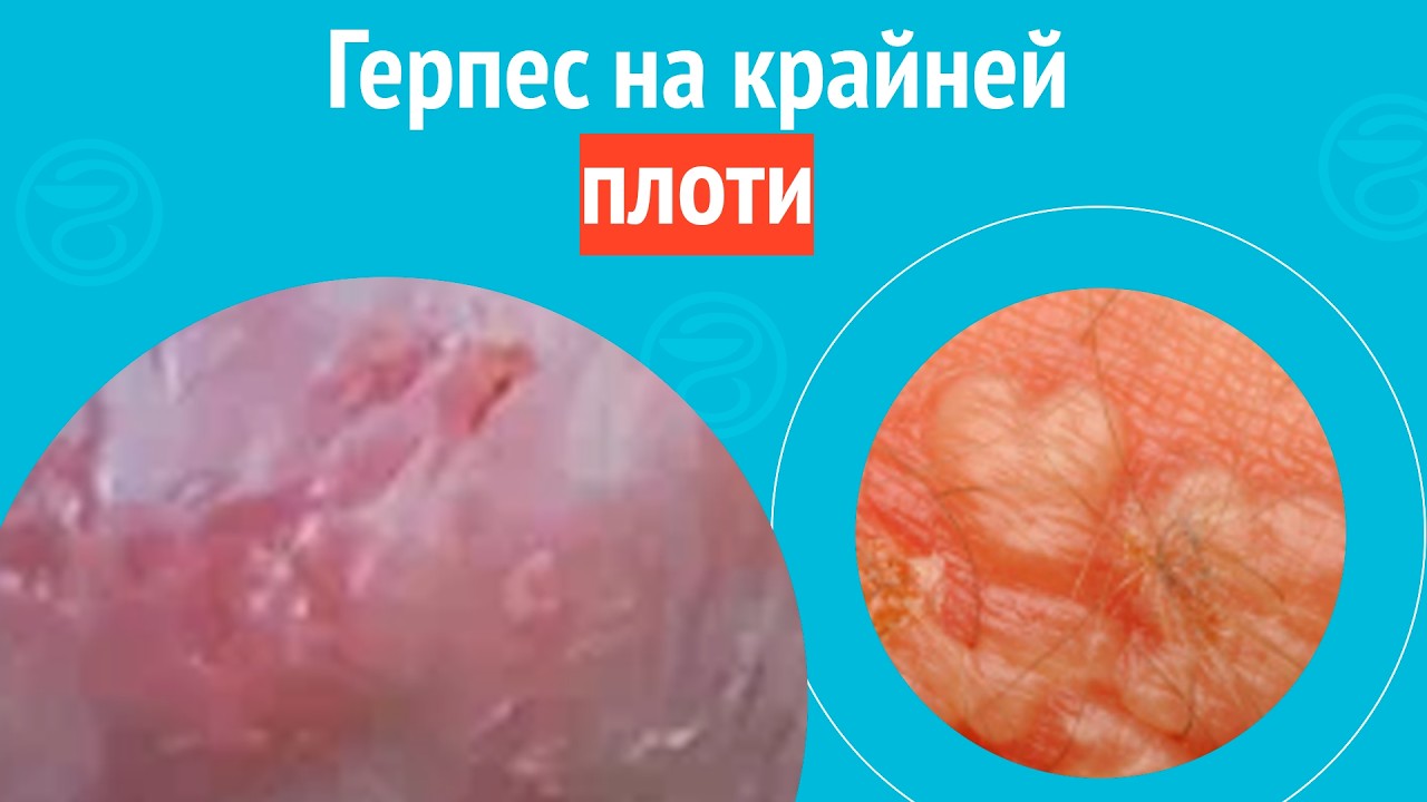 ➡️ Герпес на крайне плоти. Клинический случай № 1740