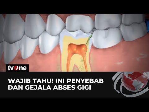 Video: Apakah abses gigi umum terjadi?