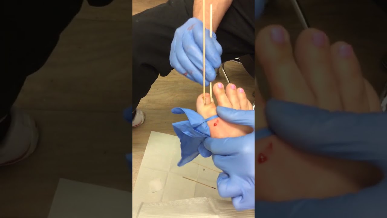 A Permanent Fix For Ingrown Nails YouTube