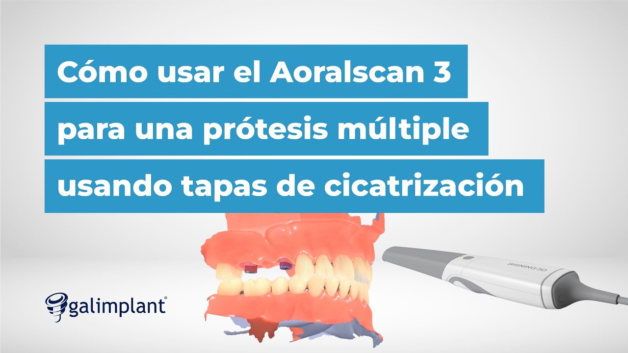 💻 Cómo utilizar el escáner intraoral Aoralscan 3 en una prótesis múltiple con tapas de cicatrización