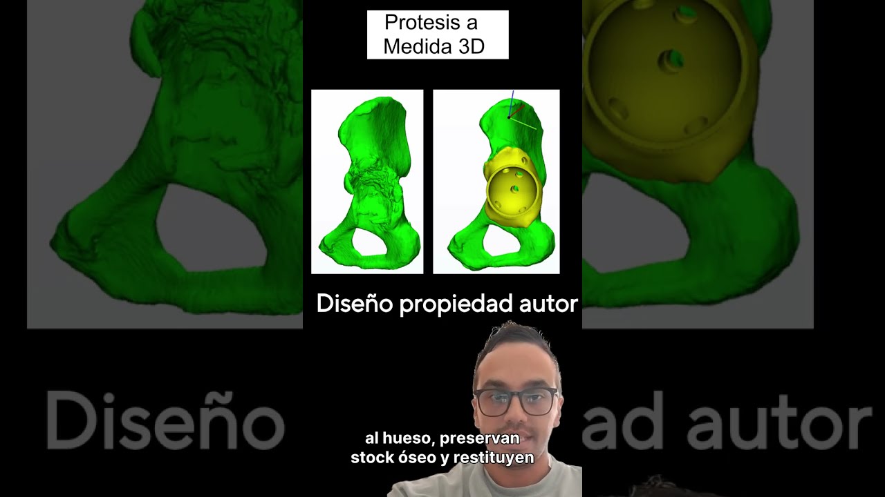 Como diseñar implantes acetabulares en 3D, QUE DICE LA EVIDENCIA CIENTICA?