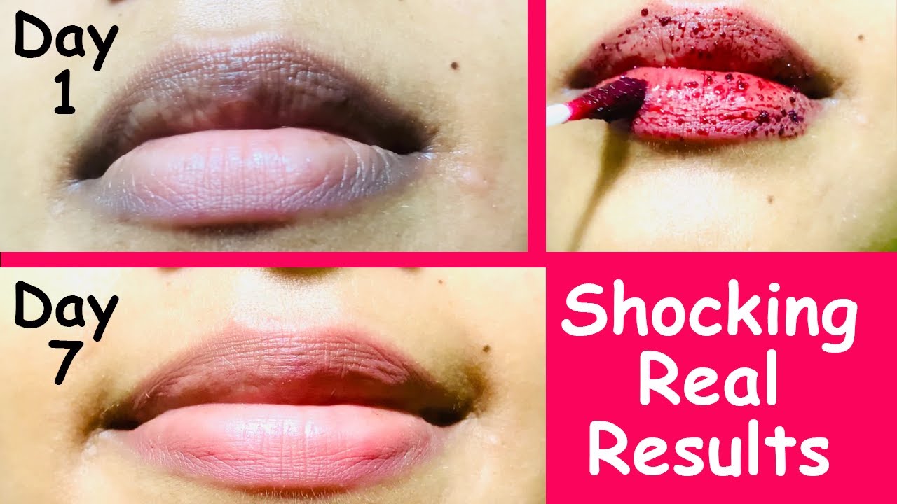See My Dark Lips Before And After Removed Dark Lips In 7 Days Using See My Dark Lips Before And After Removed Dark Lips In 7 Days Using
