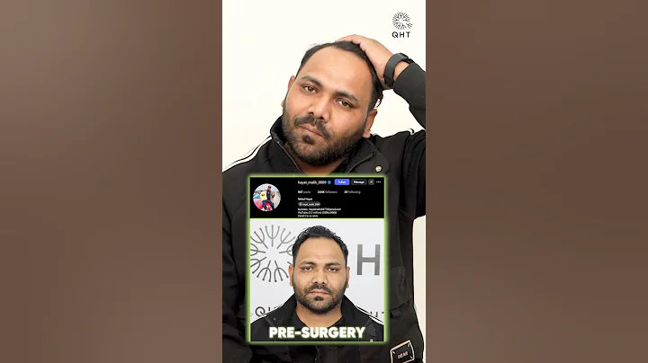 Five Months Hair Transplant Results | 3200 Grafts Implanted | #shorts #viral #hair transplant