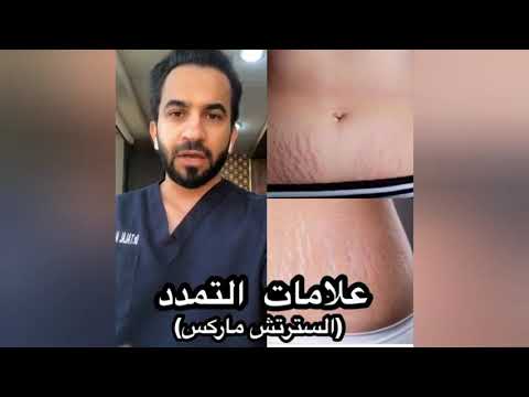 علامات تمدد الجلد السترتش مارك العلاج الوحيد دكتور طلال