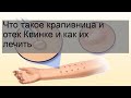 Что такое крапивница и отек Квинке и как их лечить