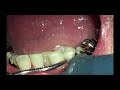 上尾の歯医者の歯周病・口臭予防の歯石取り動画 R5年10月20日 | 健康・口腔ケア