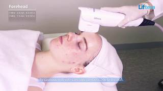 LIFTERA - Non Invasive Facelift with Line Type Cartridge
