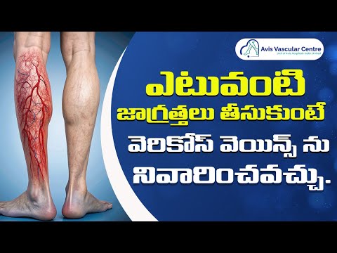 How to Sit and Stand Correctly to Protect Your Veins | Dr Rajah V Koppala | Avis Hospitals
