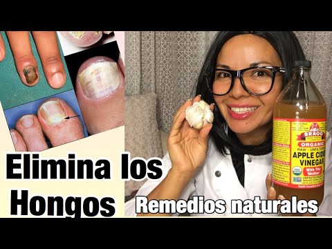 remedios caseros para eliminar hongos en las uñas delos pies