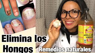 Como eliminar los hongos de las uñas de los pies, de las uñas de las manos y de la piel