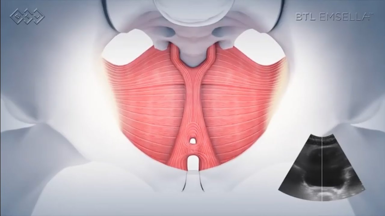 The Emsella Chair for Pelvic Floor Rehab - YouTube