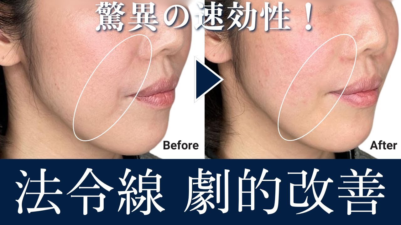 【ヒアルロン酸】でリフトアップできる！症例や入れた量もご紹介します！