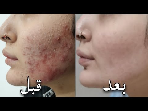 دكتور جلدية يكشف عن علاج حب الشباب