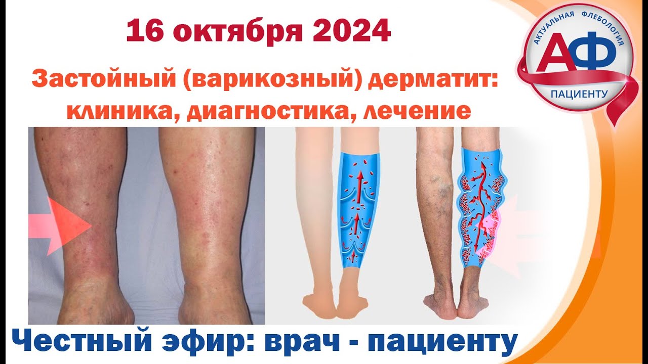 Застойный варикозный дерматит клиника, диагностика, лечение