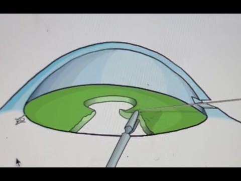 How to repair an iris defect after cataract surgery. Graphics by Dr Karrar Ali Altufeili