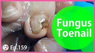 TOP MEDICAL PEDICURE Ep 159 Treatment for serious fungus toenail