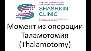 Таламотомия (Thalamotomy)- нейрохирургическое лечение болезни Паркинсона (Клиника "Shashkin clinic")