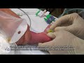 Paediatric anaesthetics chapter 7  long saphenous iv neonate 1