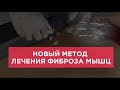 НОВЫЙ МЕТОД лечения Фиброза Мышц и Триггерных точек. Моксотерапия. Миопрессура Одесса