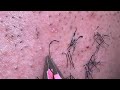 Plucking facial hair & ingrown hair 384 頬髭抜き(埋没毛あり)