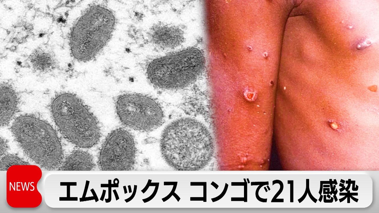 エムポックス(サル痘) コンゴで21人感染 今年(2024年)アフリカで500人超死亡 - YouTube