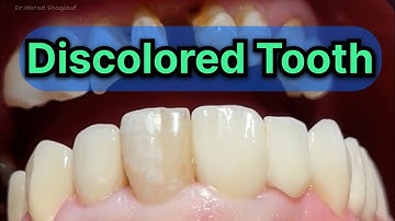 Composite veneer for single central incisor