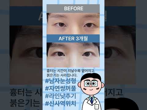 남자 자연쌍꺼풀 낮추기 전후