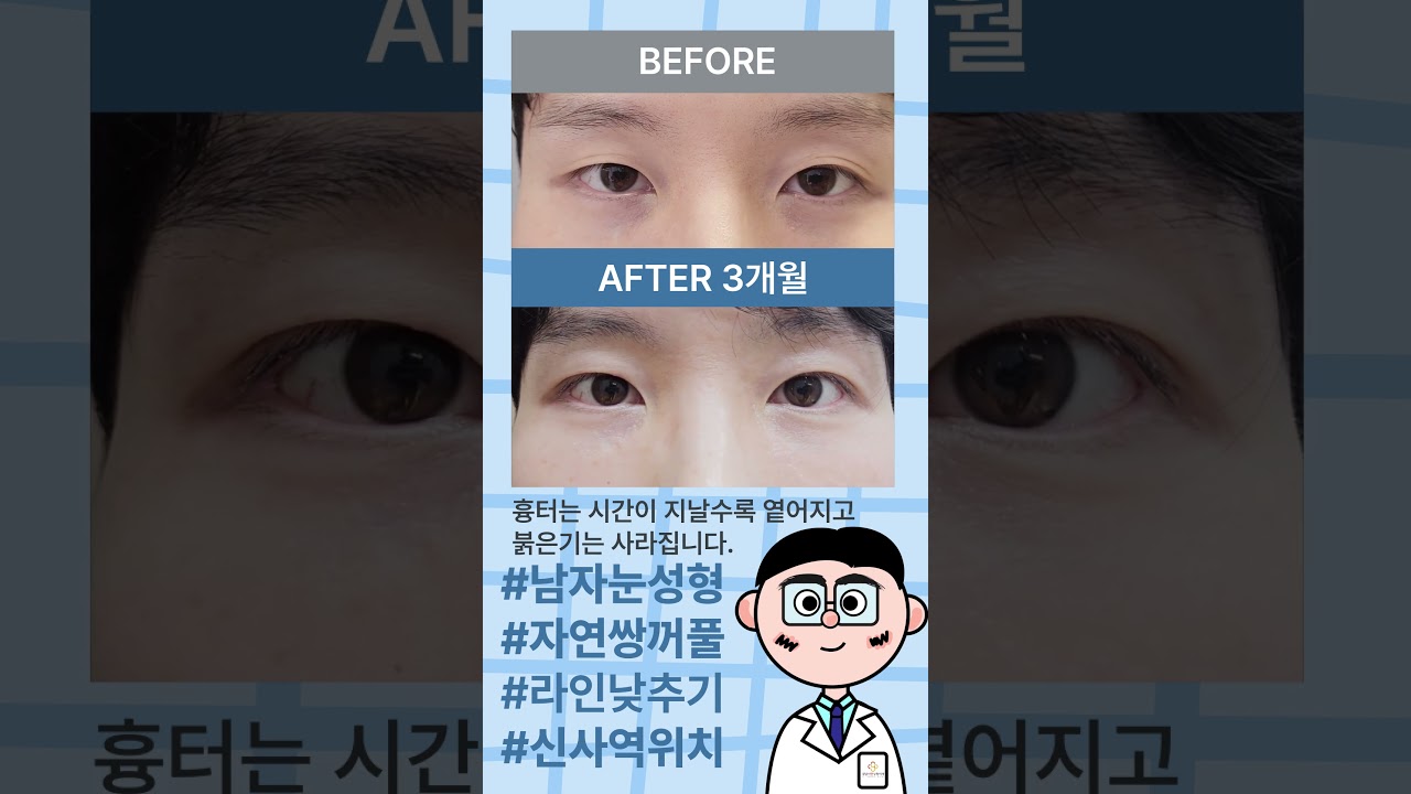 [Ганнам Сөёон Гоо сайхны мэс заслын эмнэлэг] Эрэгтэй байгалийн давхраатай зовхийг намсгах өмнө ба хойно