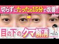 【目の下のクマ】切らずに15分でできる目元の若返り治療
