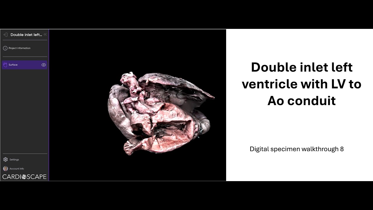 Digital walkthrough 8 - Double inlet left ventricle | Cardiac anatomy ...