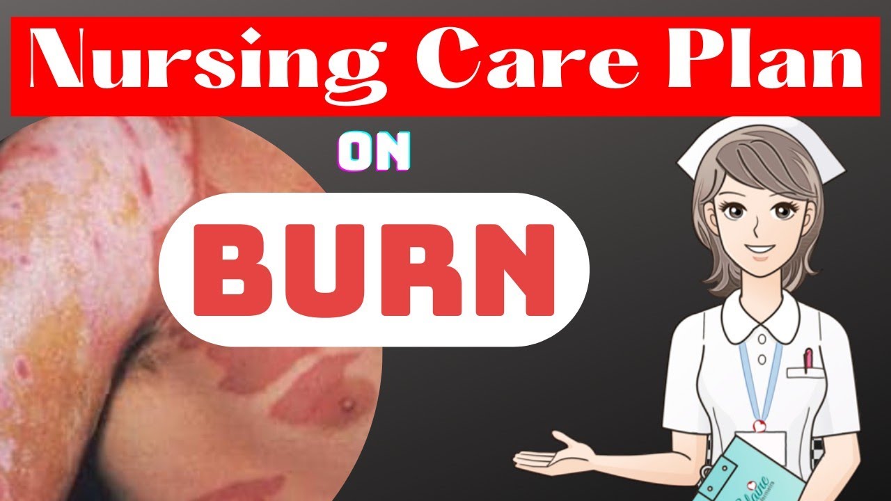 nursing care plan of burn injury NCP for burns burn injury nursing care plan ncp on burn