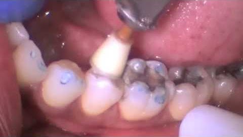 Class II Dental Restoration- Single Step Finish | Dentsply Sirona