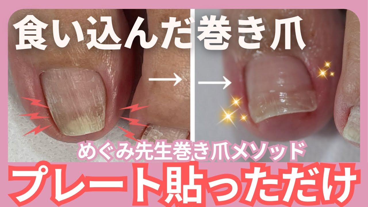 食い込んだ巻き爪をたった1回で広げた方法|めぐみ式巻き爪ケアメソッド