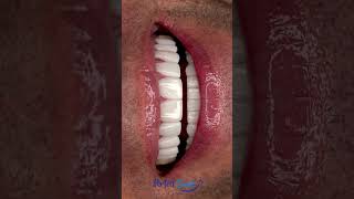 Mark got his $3.5 million dollar perfect Smile!!