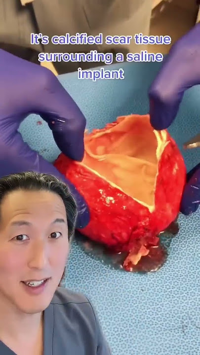 When Your Breast Implant Develops an Egg Shell Around It! #shorts #breastimplantsurgery