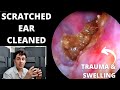 Scratched Swollen Ear Cleaned Using Suction (PAMPS & DAMPS Explained)