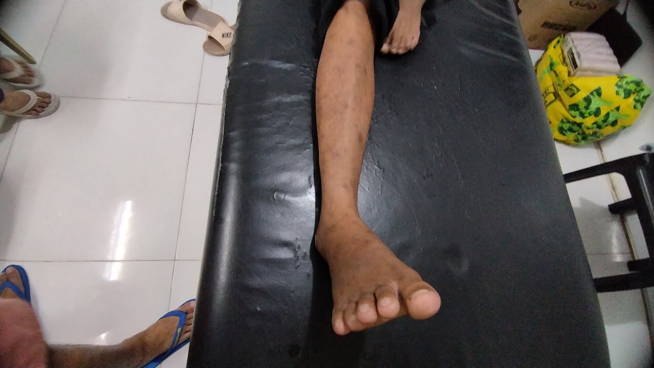 😱🦵SYETENG PAA dahil sa aksedente 😱 naayus pa kaya ni master ..3 months Ng DALA dala..