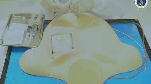 Totally Implantable Venous Access Device : Rama Home Chemotherapy