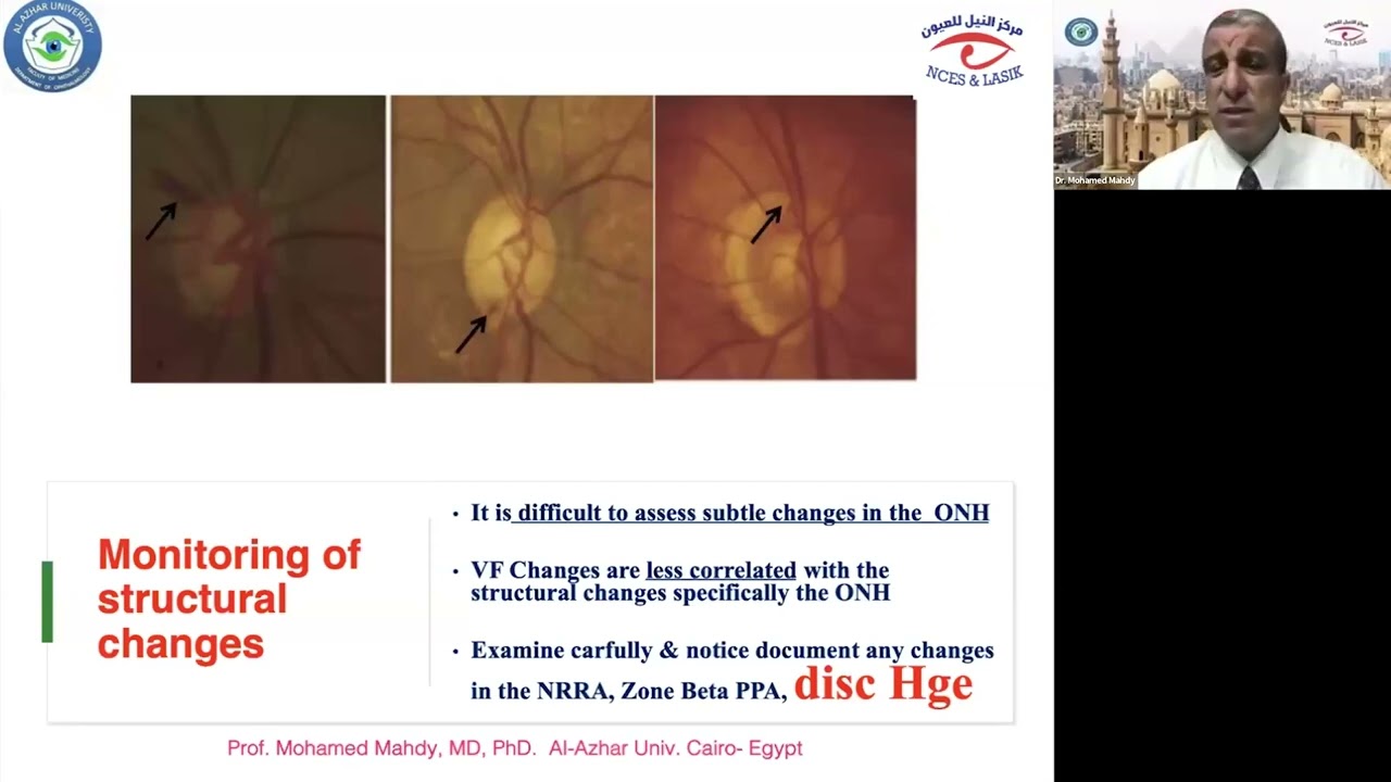 Lecture: Management of Advanced Glaucoma Patient