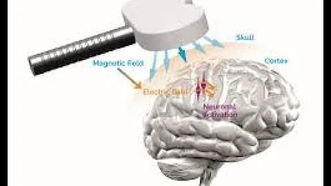 Transcranial Magnetic Stimulation (TMS) for Depression and Obsessive Compulsive Disorder (OCD)
