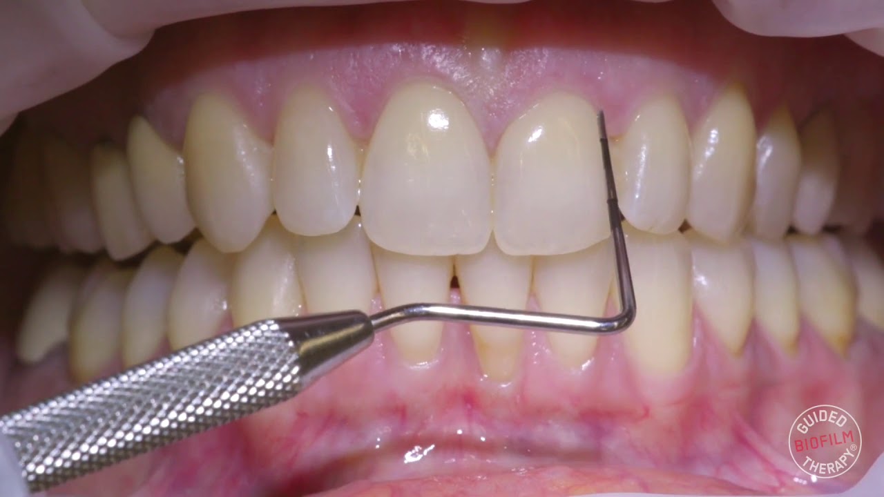 How to clean teeth YouTube