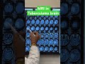 Neuroimaging in CNS Tuberculoma – Key Diagnostic Clues- MRI Brain in Tuberculoma #tuberculoma