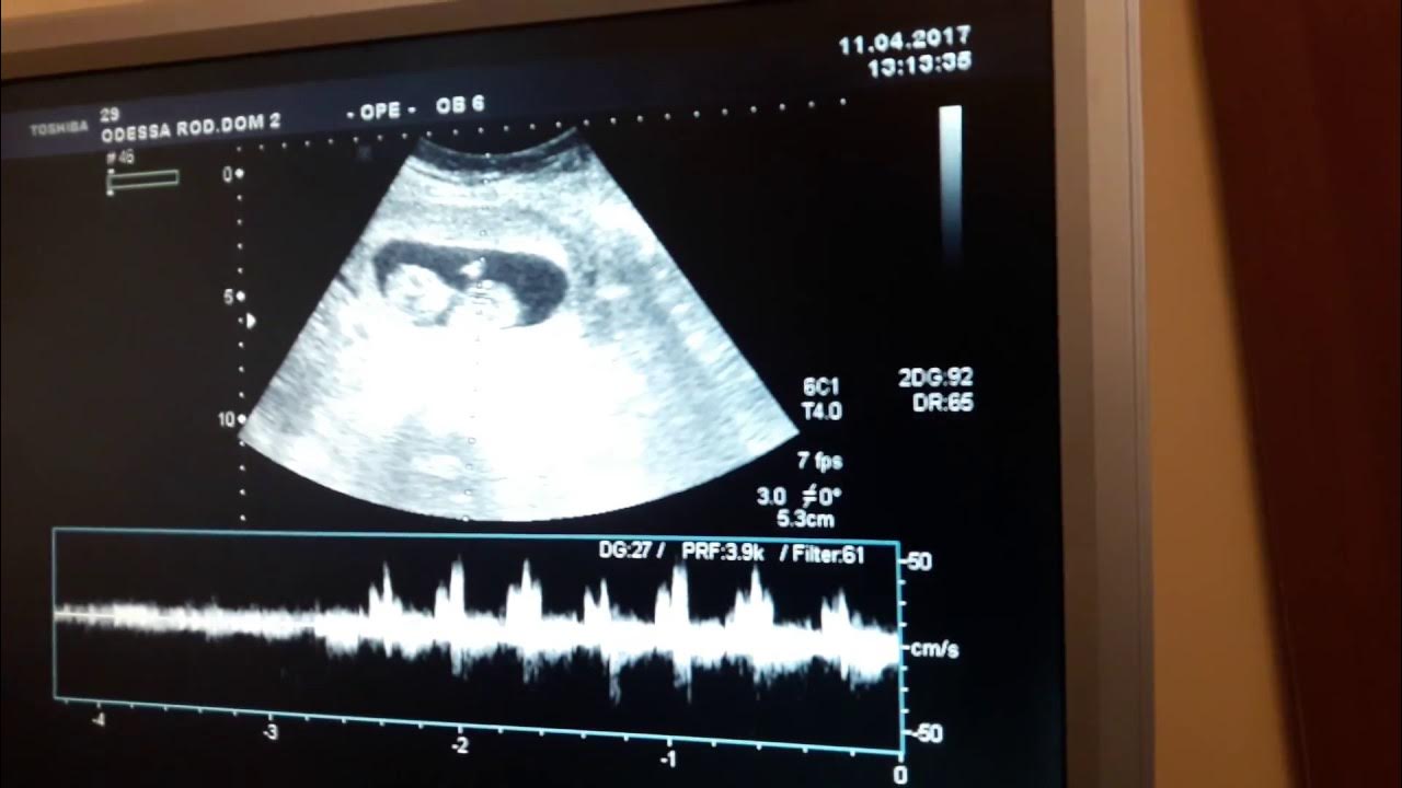 Узи 5-6 недель беременности сердцебиение. Узи 5-6 недель беременности сердцебиение. Узи 6 недель беременности сердцебиение. Не слышно сердцебиение на 7 неделе. Норма чсс по неделям беременности у плода.