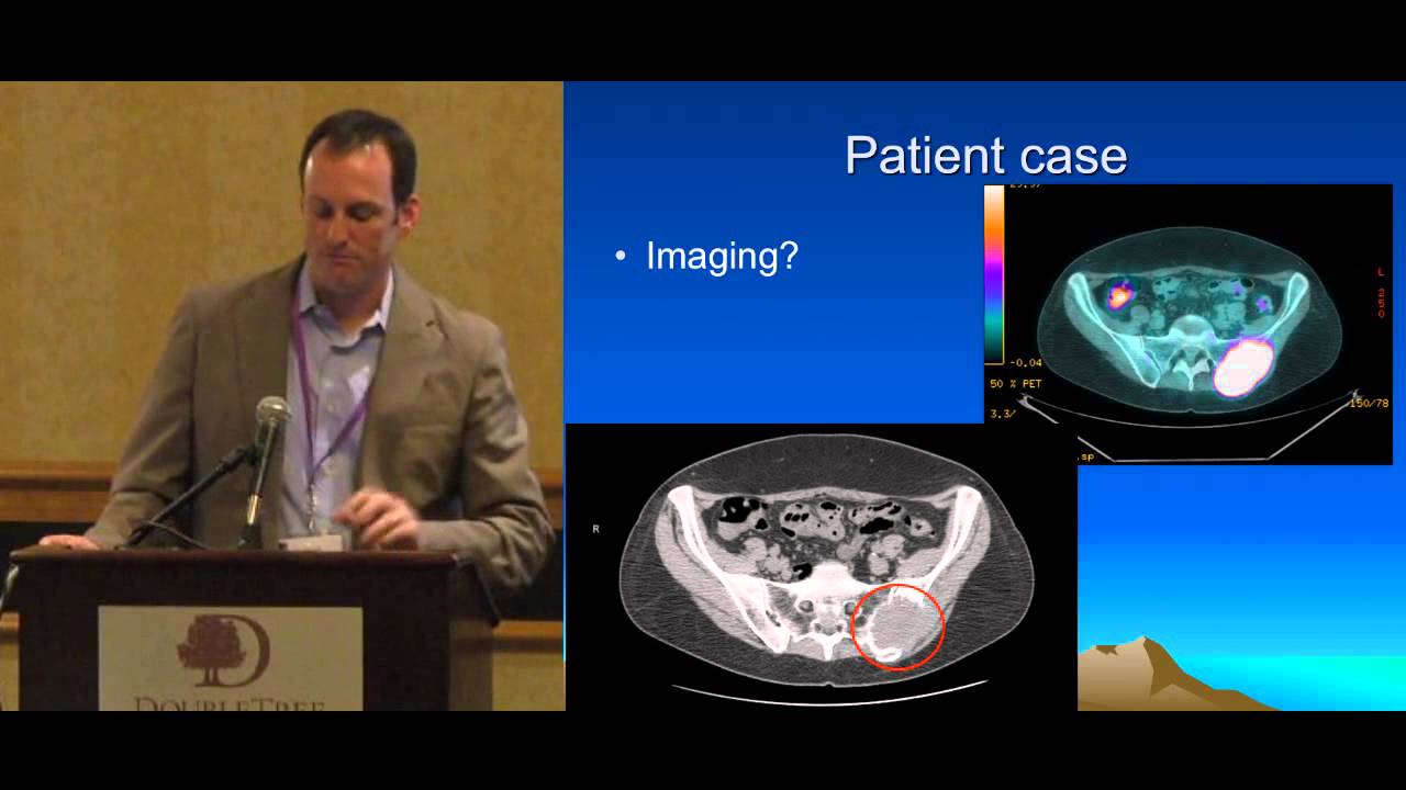 Thyroid Cancer: Radioactive Iodine Ablation, New Research Data. Dr. Klopper. ThyCa Conference