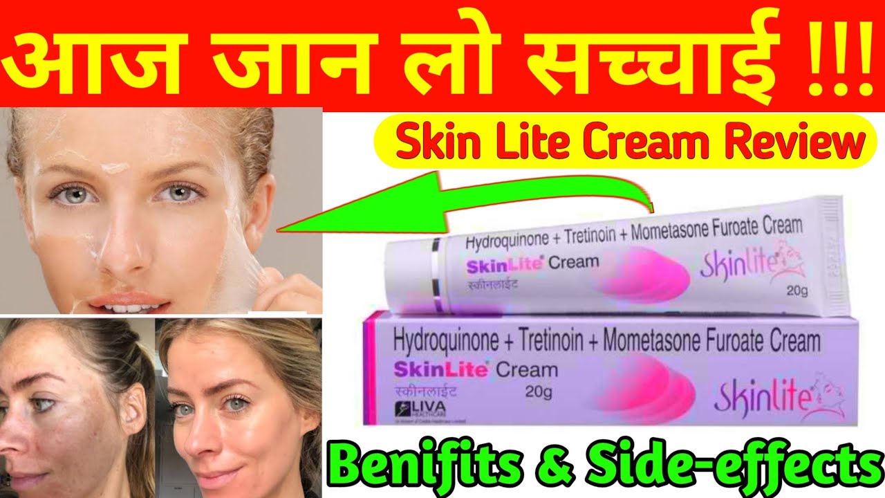 Skinlite Cream से आखिर कैसे होता है चेहरा साफ | Skinlite Cream Review | लगाने से पहले देख लो 