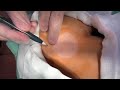 ① 粉瘤くりぬき法 epidermal cyst atheroma cystic acne extractions 脂肪腫 lipoma 大阪心斎橋 大阪梅田院 名古屋栄院 福岡天神院 西宮院 尼崎院